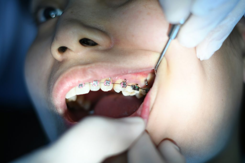 Why Is Flossing So Hard with Braces? 10 Essential Flossing Tips for Teenage Braces Wearers